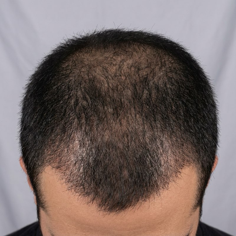 After hair growth treatment - Top View